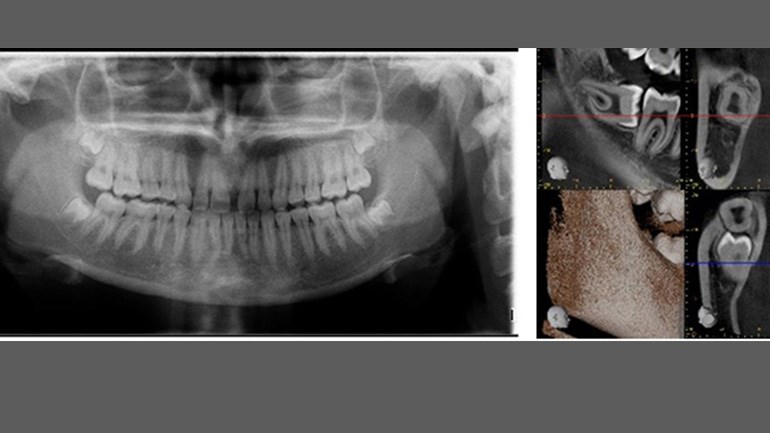 Panoramaröntgen och CBCT-röntgen.
