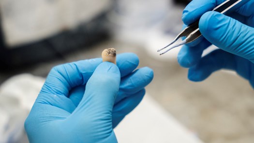 Person med skyddshandskar och pincett håller i tand med karies.